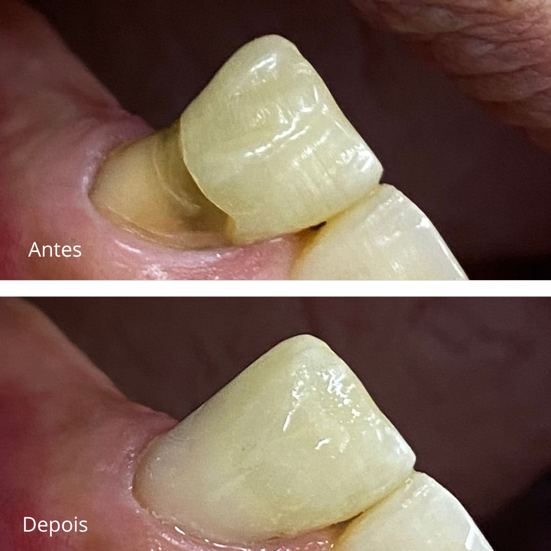 Antes e Depois Implante